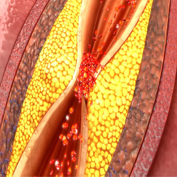 What is stable coronary artery disease?