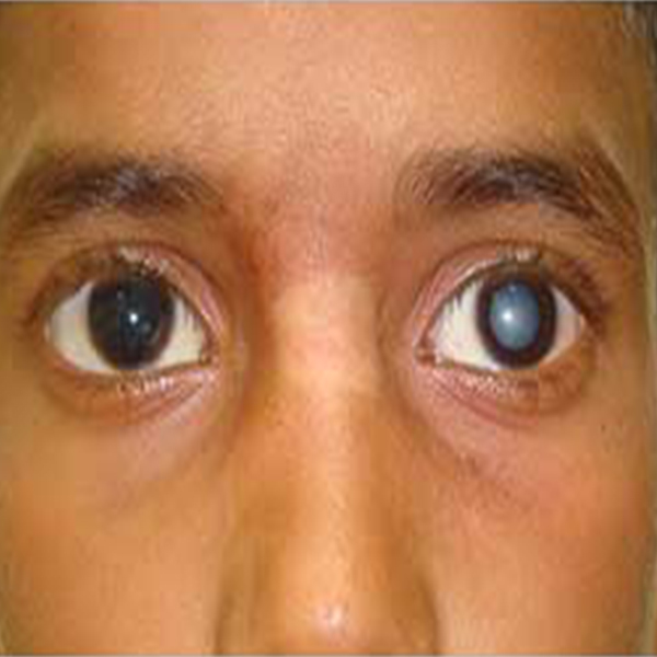 What about Cataract in children?