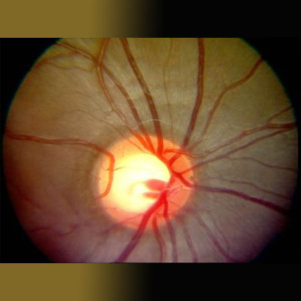 What is steroid induced