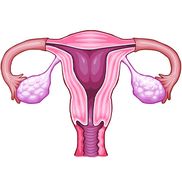 What are the basic investigations of PCOS?