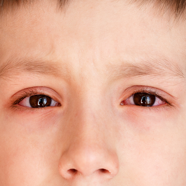 What are the common eye diseases in children?