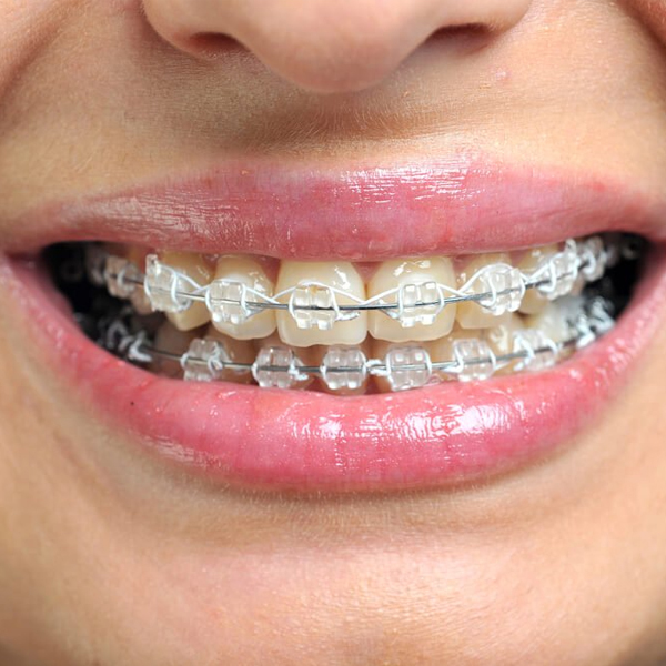 What everybody should know about dental braces?