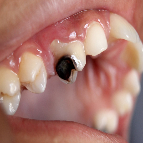 What everybody should know about Dental Caries? FAQ answered by Dr