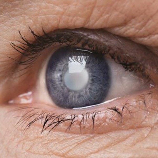 Cataract Surgery
