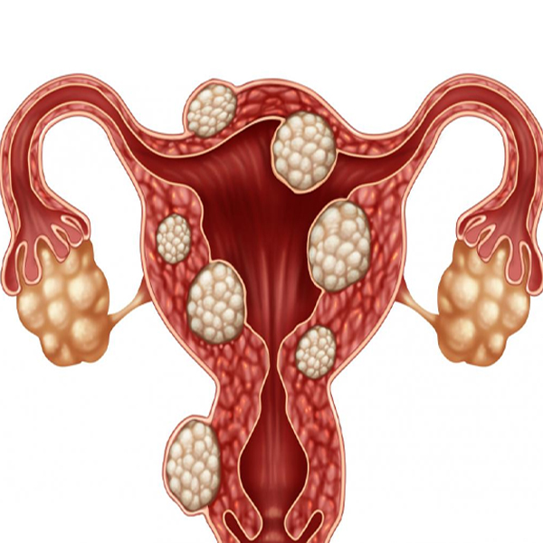 What is the treatment for fibroid?