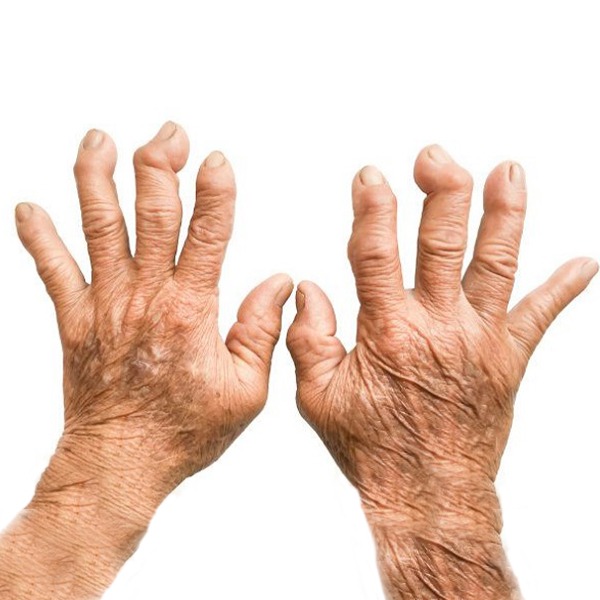 सोरियाटिक गठिया के बारे में सब जाने | Psoriatic Arthritis in Hindi