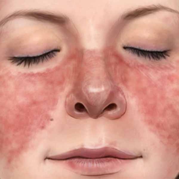 लुपस के लक्षण, कारण, उपचार, दवा, इलाज और परहेज Lupus Ke Karan