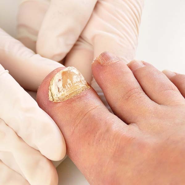 Paronychia Nail Infection Treatment in Kolkata | Manipal Hospitals