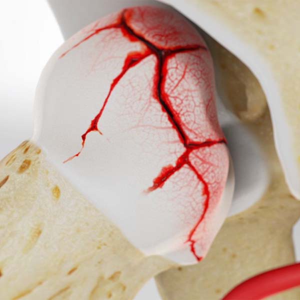 पर्थेस रोग क्या है? कारण, लक्षण और इलाज Perthes Disease in Hindi